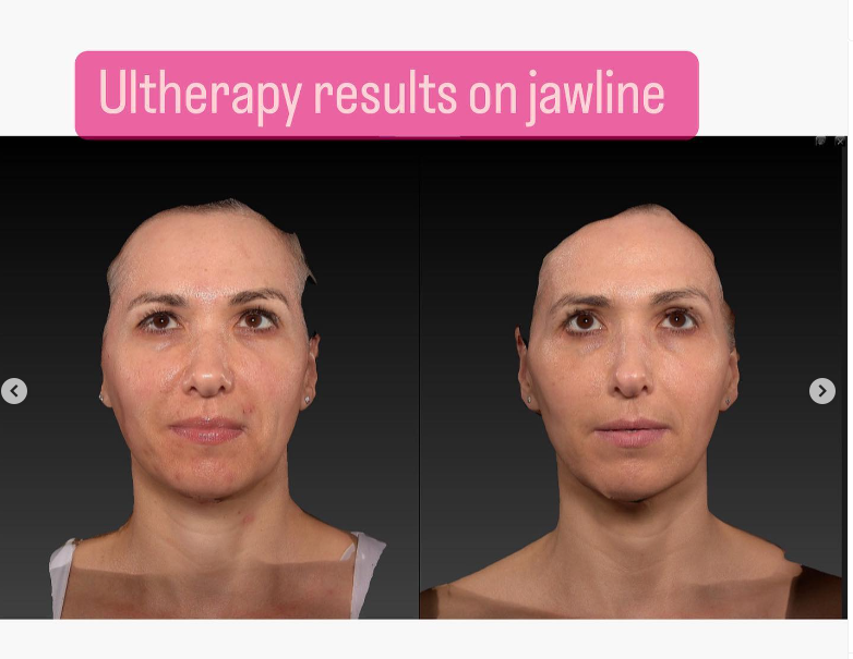 Under skinvestigation: Ultherapy