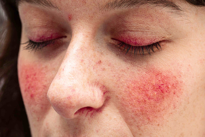The Derm-approved Rosacea Routine