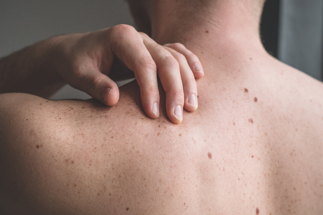 A Nerdie Guide to Moles & Sun Safety