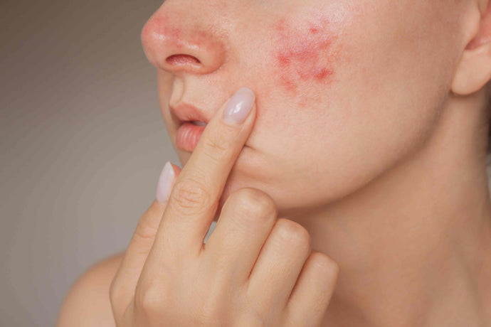 Is it acne or rosacea?