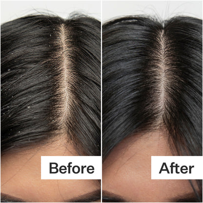 Act+Acre Salicylic Acid Scalp Exfoliator