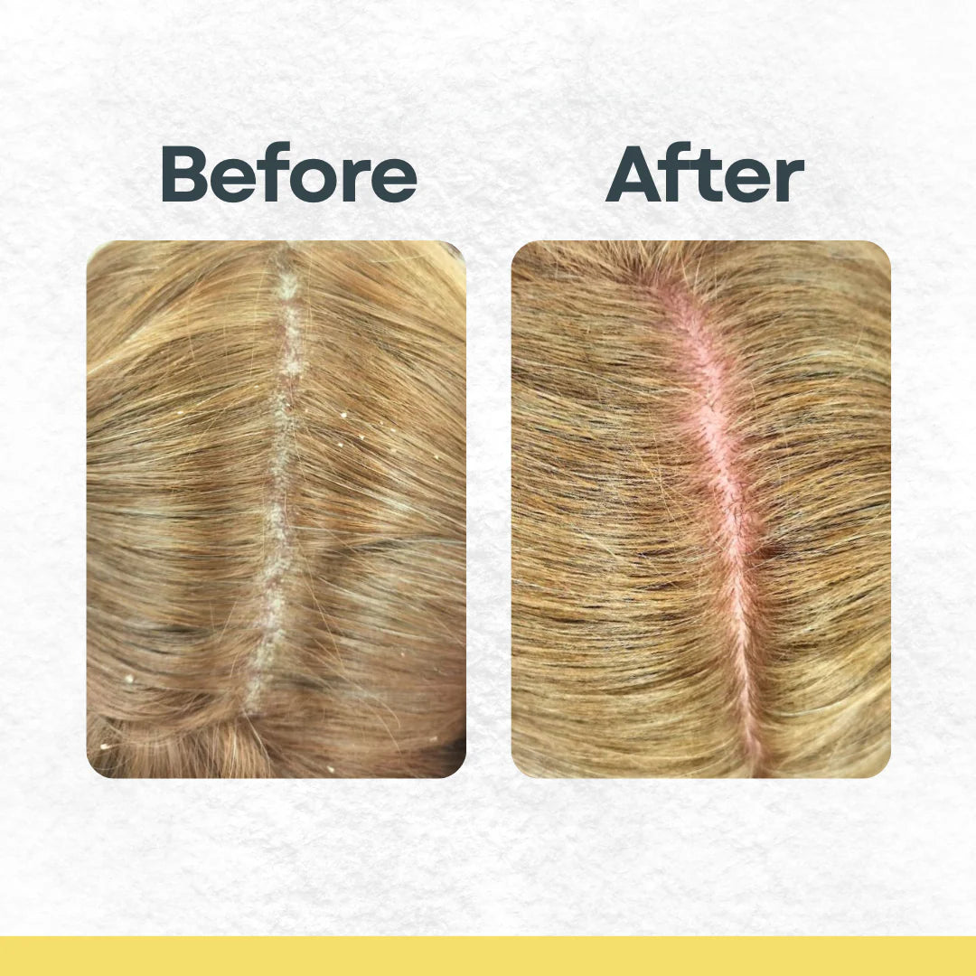 Remi EX | Bye Bye Build Up Scalp Exfoliator