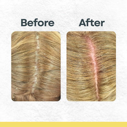 Remi EX | Bye Bye Build Up Scalp Exfoliator